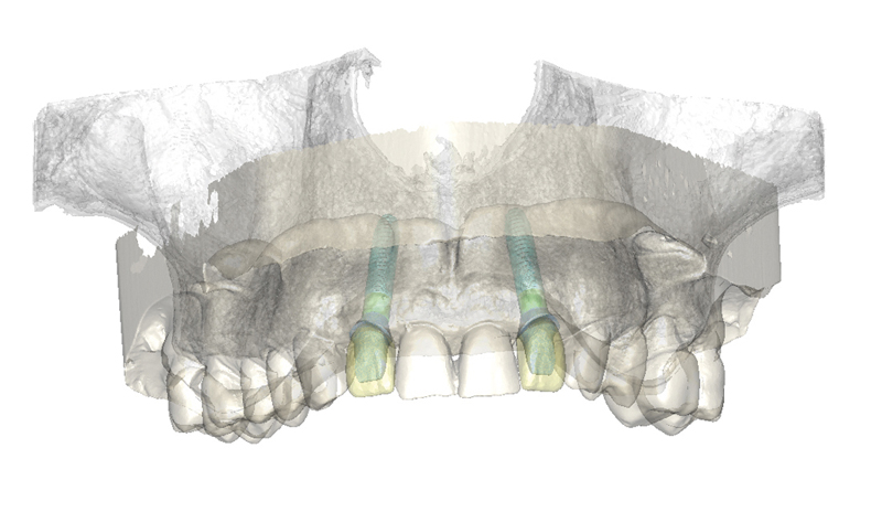 Simplant 1220083 ISfAA indication Multiple single tooth restorations web